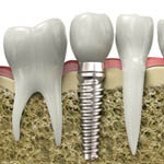 Mission Viejo dental implants